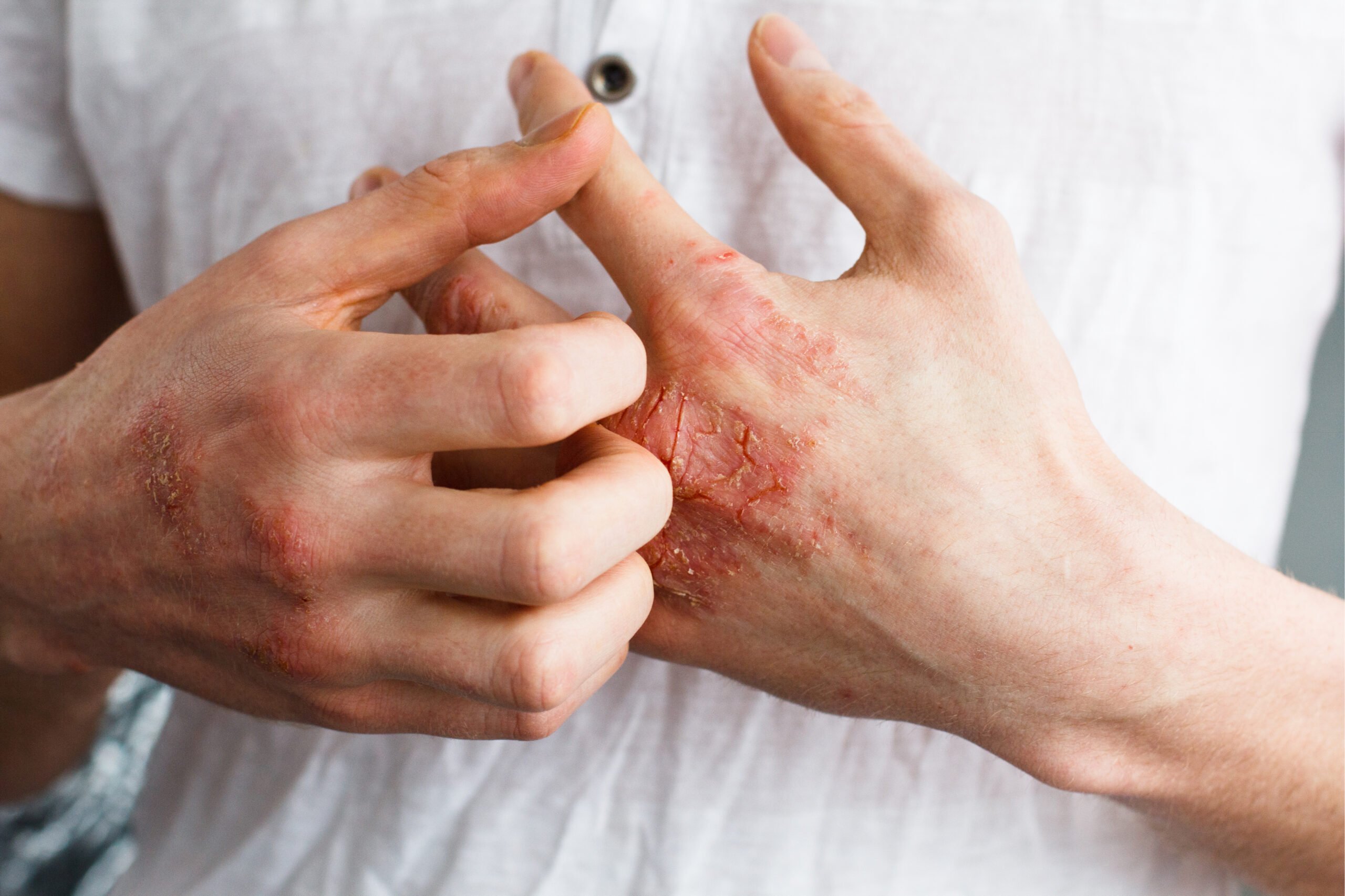 Causes of eczema for Atlanta patients