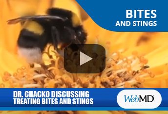 Dr. Thomas Chacko Discussing Insect Bites and Stings on WebMD