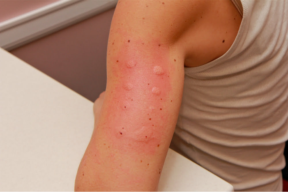 Atlanta skin prick allergy testing