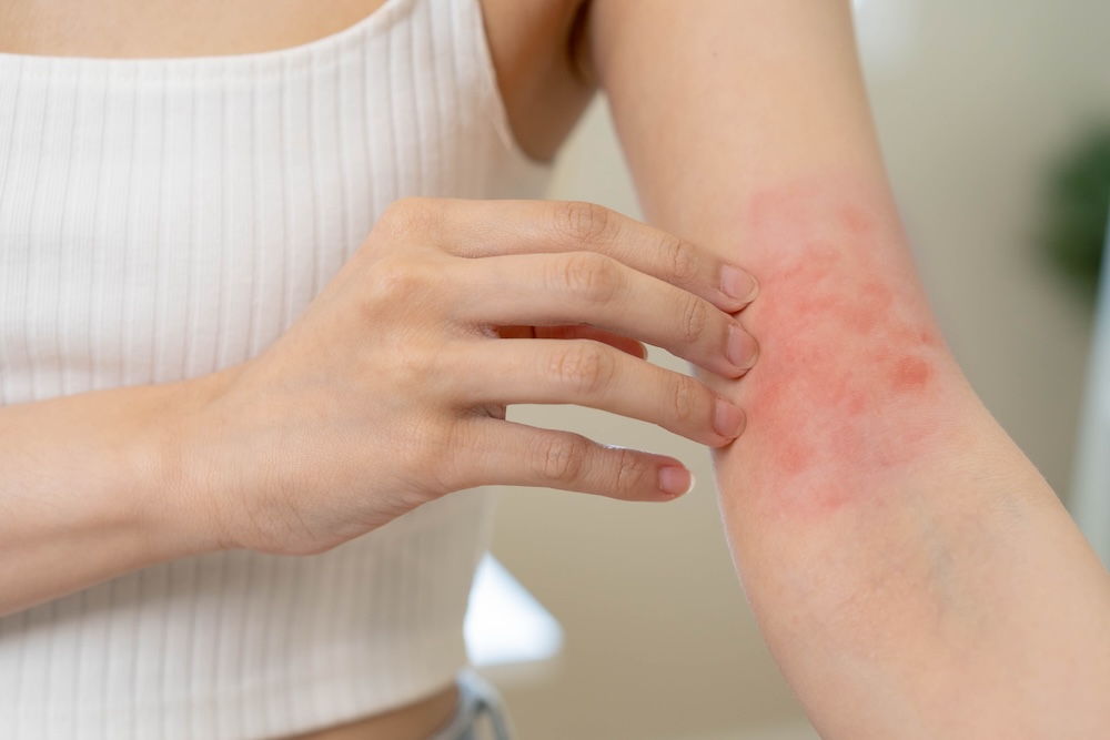 Atlanta skin allergy symptoms.