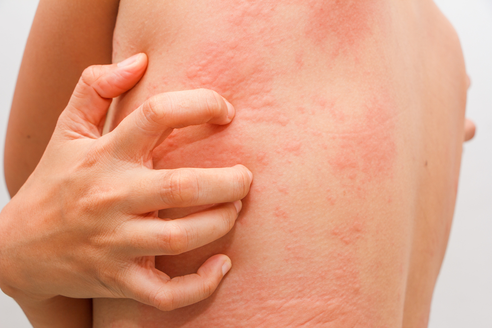 Skin allergies in Atlanta, GA.